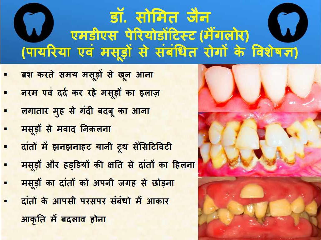 7-SIGNS-OF-GUM-DISEASE-BY-DR-SOMIT