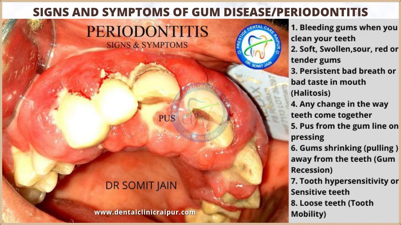 8 Signs and symptoms of gum disease or periodontitis
