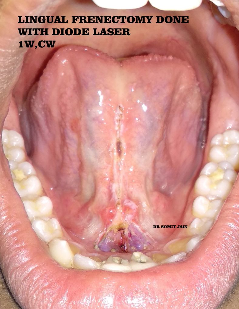 ANKYLOGLOSSIA OR TONGUE TIE DIODE LASER LINGUAL FRENECTOMY