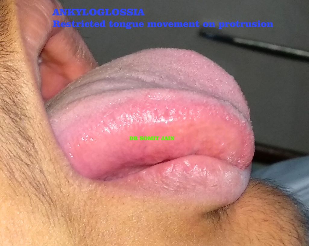 ANKYLOGLOSSIA OR TONGUE TIE RESTRICTED MOVEMENT