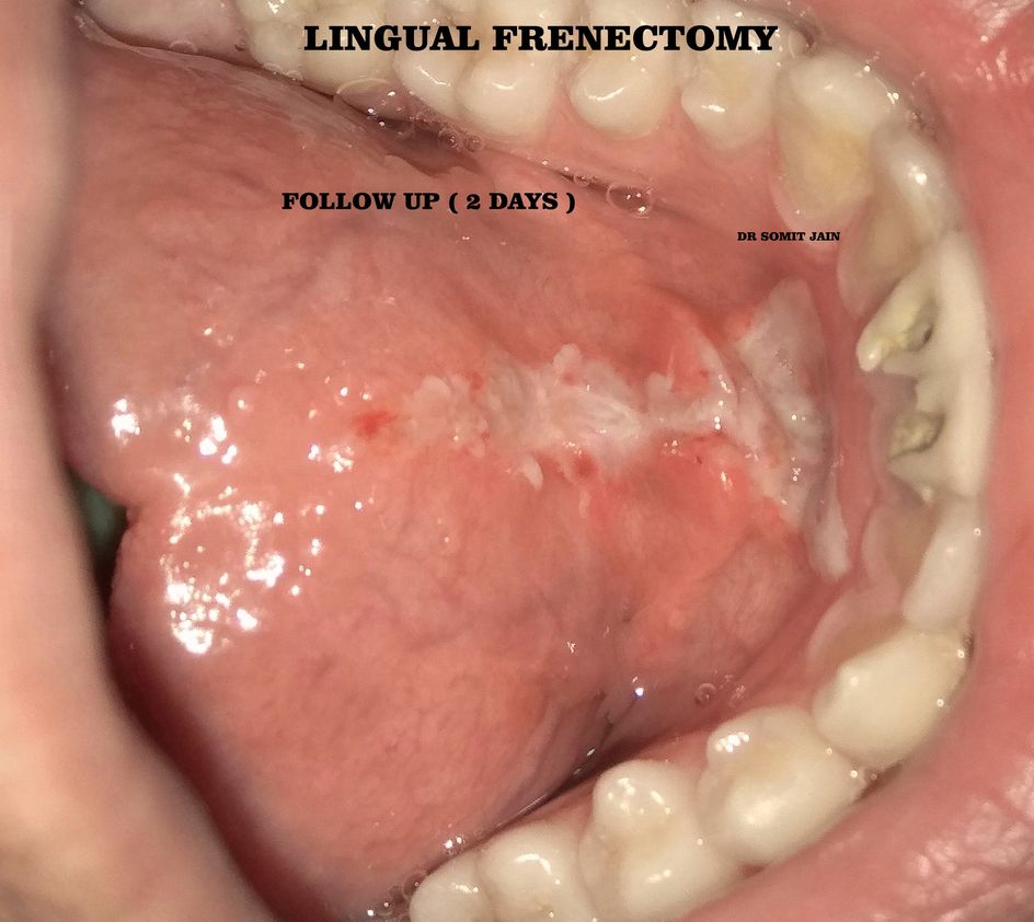 ANKYLOGLOSSIA OR TONGUE TIE SURGERY WITH DIODE LASER