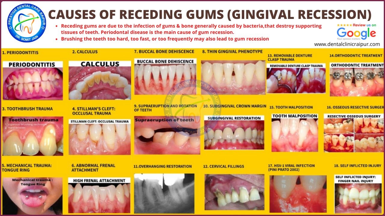CAUSES OF RECEDING GUMS (GINGIVAL RECESSION)