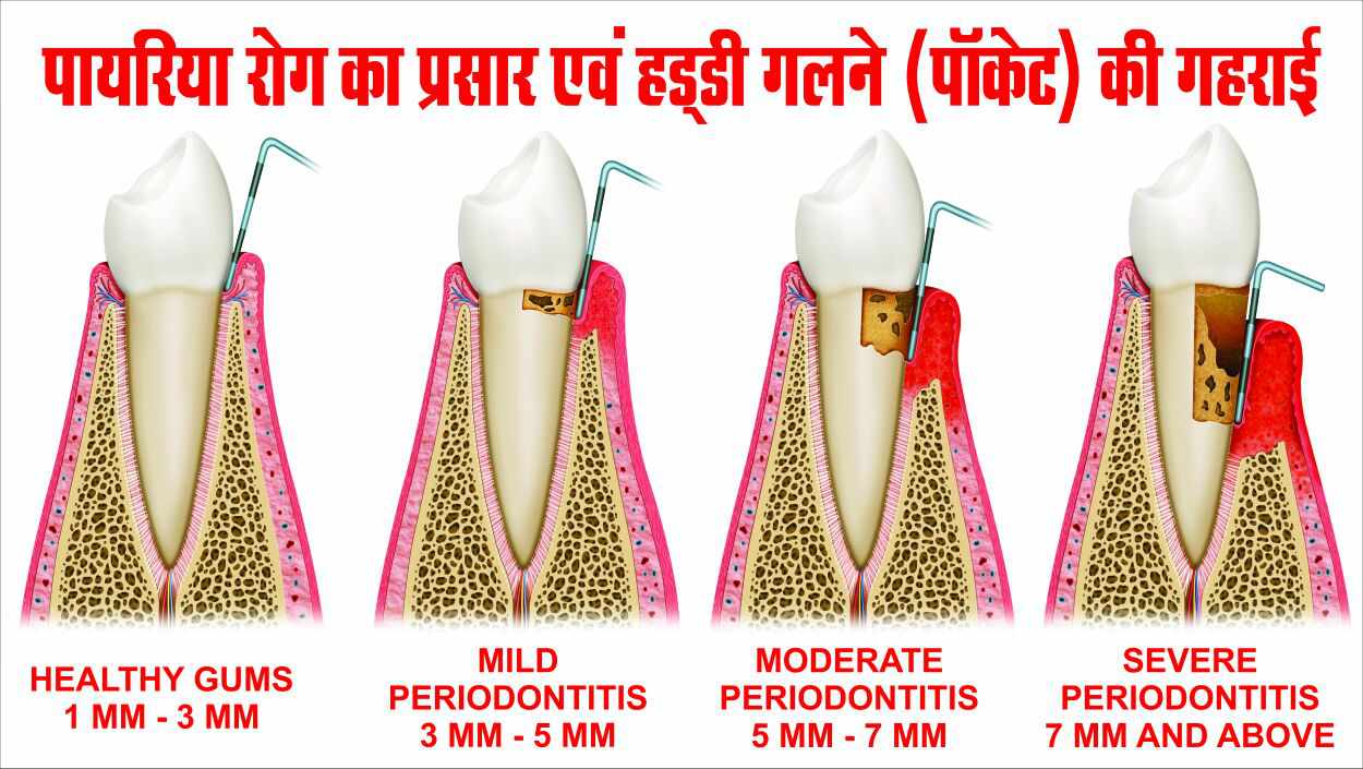 Periodontal Disease Types