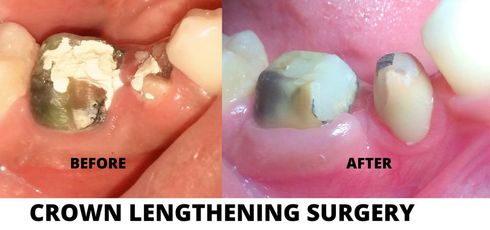 CROWN LENGTHENING SURGERY- BIOLOGIC WIDTH