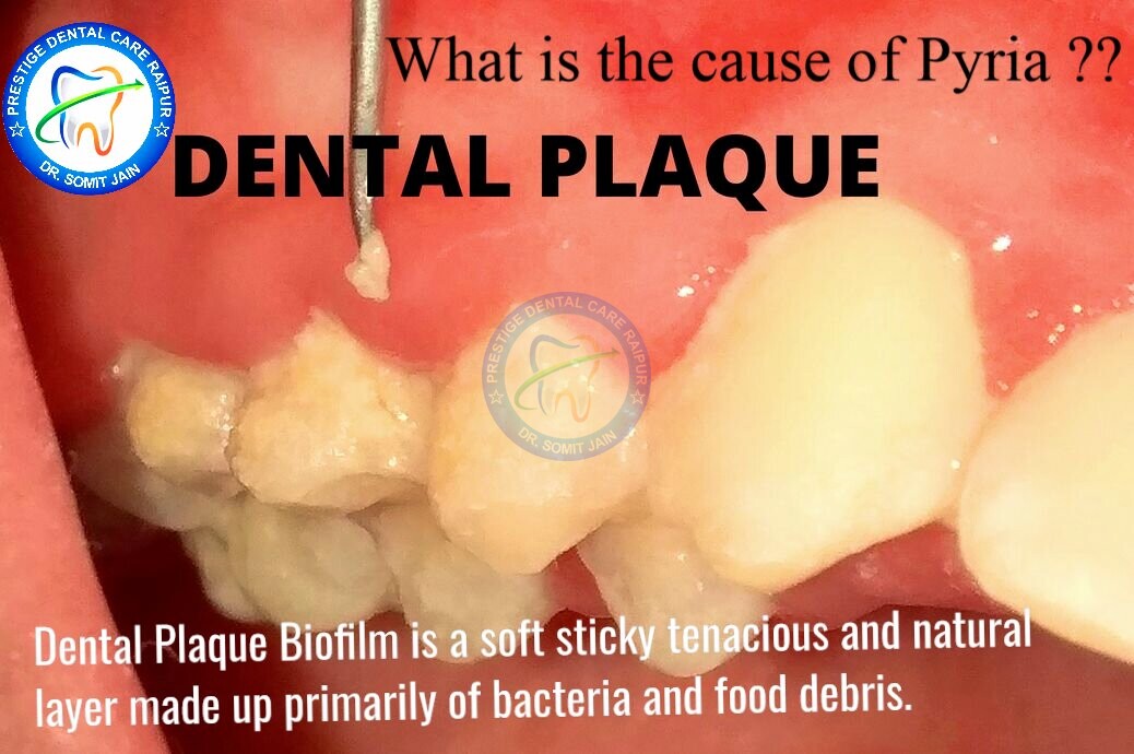 Cause of Pyria- Dental plaque
