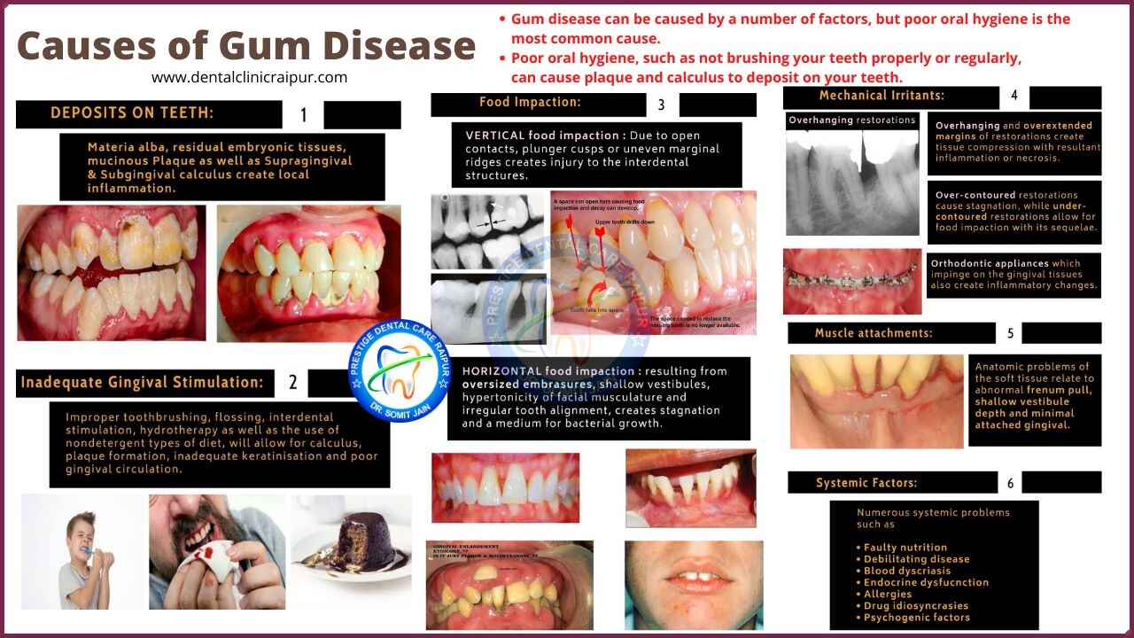 Causes of gum disease or periodontitis