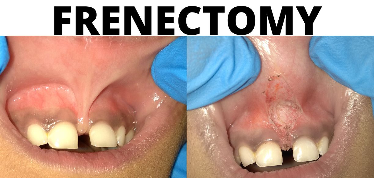 FRENECTOMY LASER MAXILLARY LABIAL