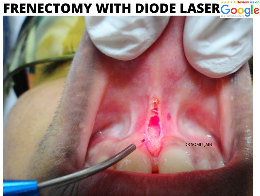 FRENECTOMY WITH DIODE LASER