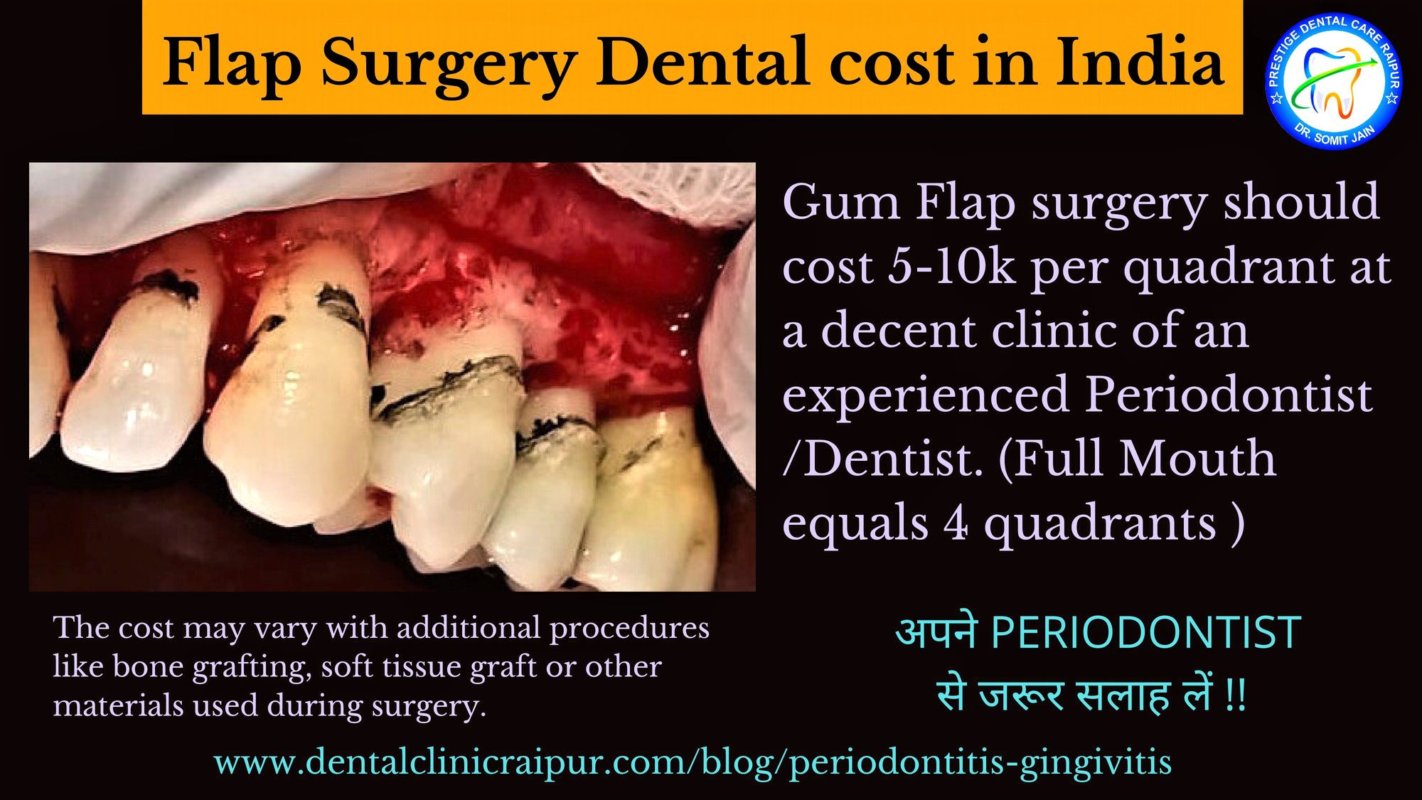 Flap Surgery Dental cost in India