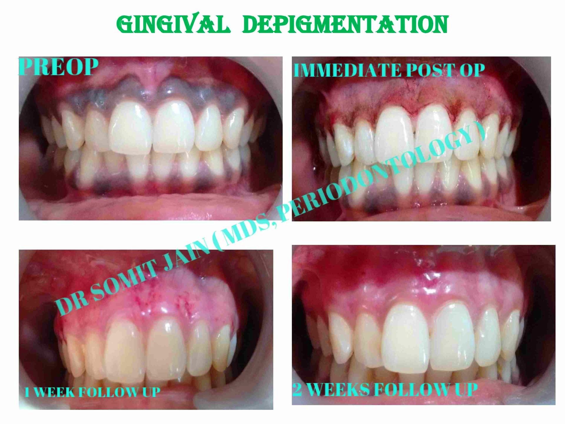 GINGIVAL-DEPIGMENTATION-WITH-DIODE-LASER-BY-DR-SOMIT-JAIN