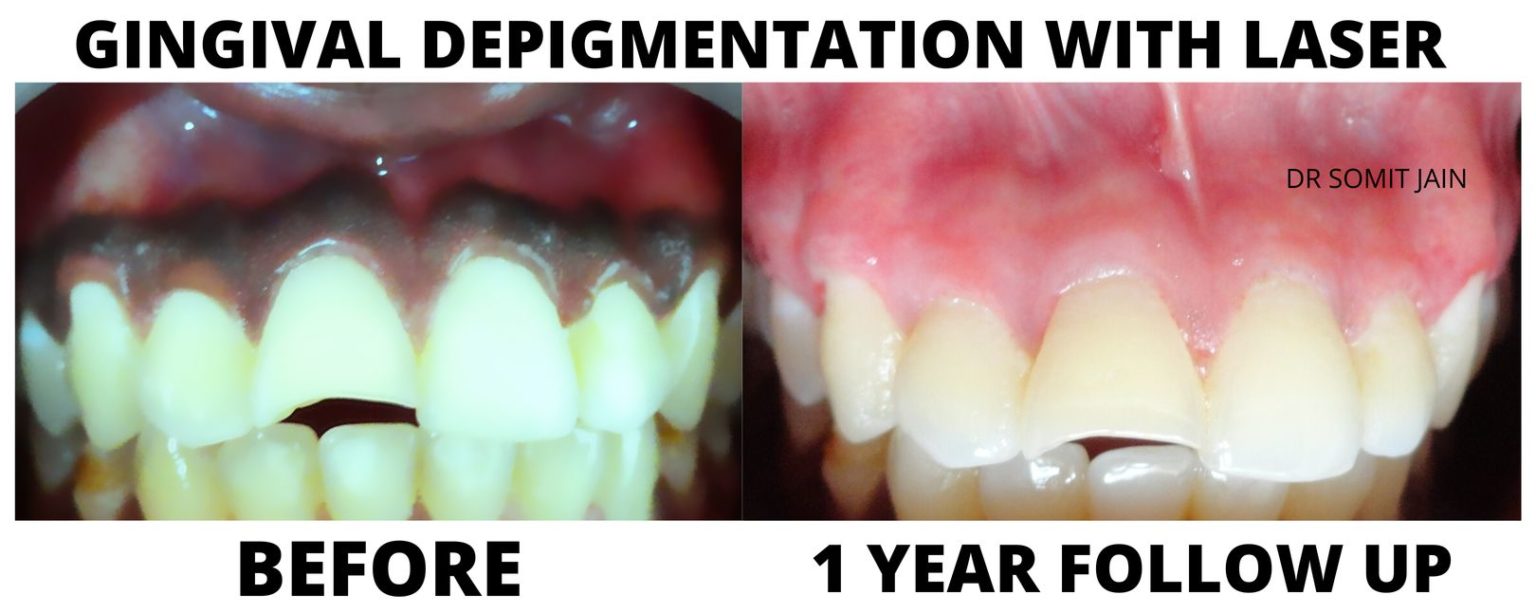 Gingival Depigmentation: Diode Laser Vs Surgical Blade; Before And ...