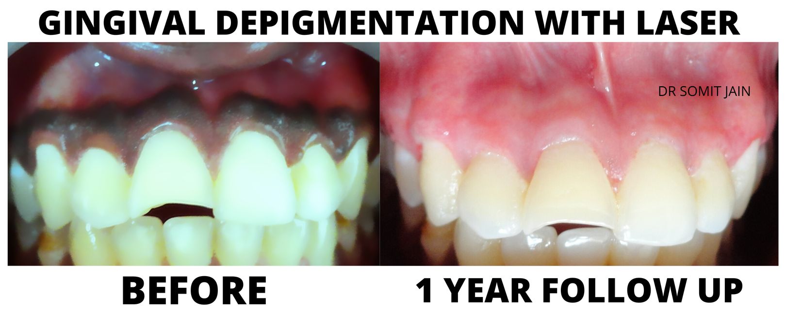 GINGIVAL DEPIGMENTATION WITH LASER