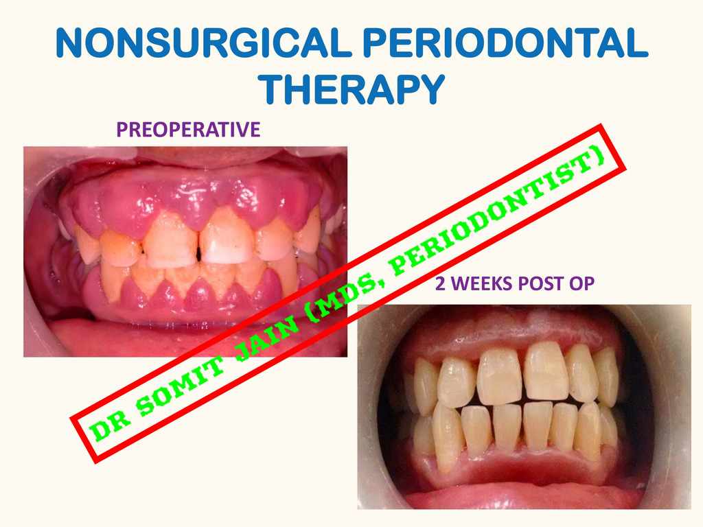 gingival enlargement (pyorrhea) treatment before and after