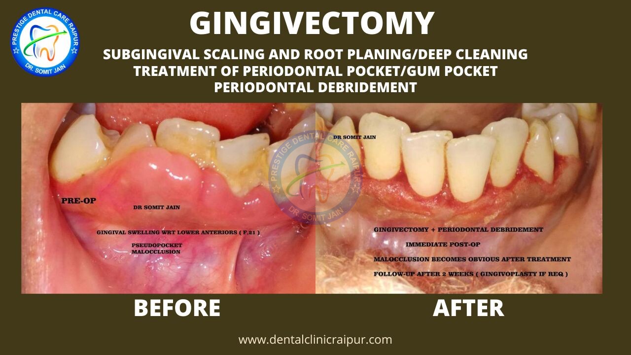 GINGIVECTOMY