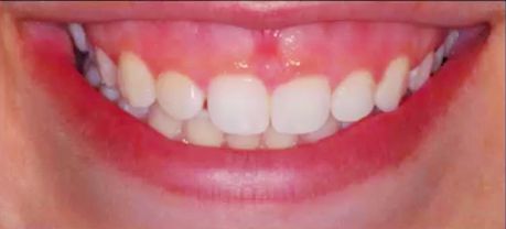 GUMMY SMILE EXCESSIVE GINGIVAL DISPLAY