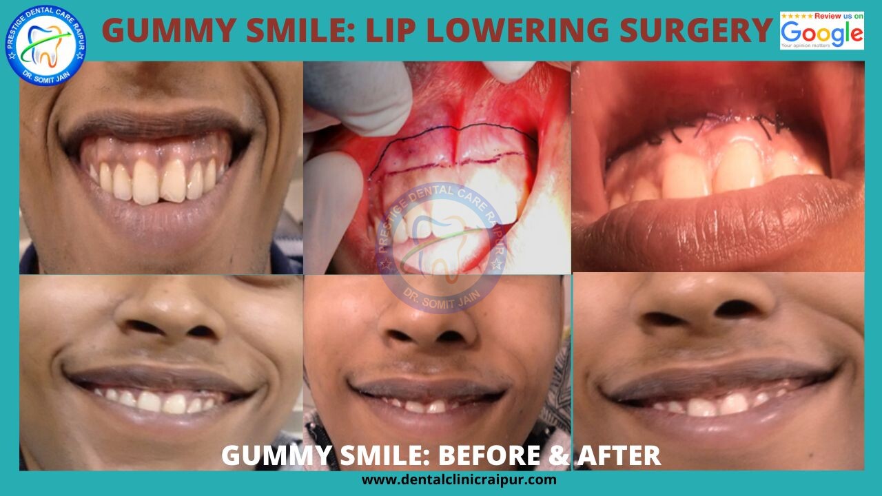 GUMMY SMILE LIP LOWERING SURGERY