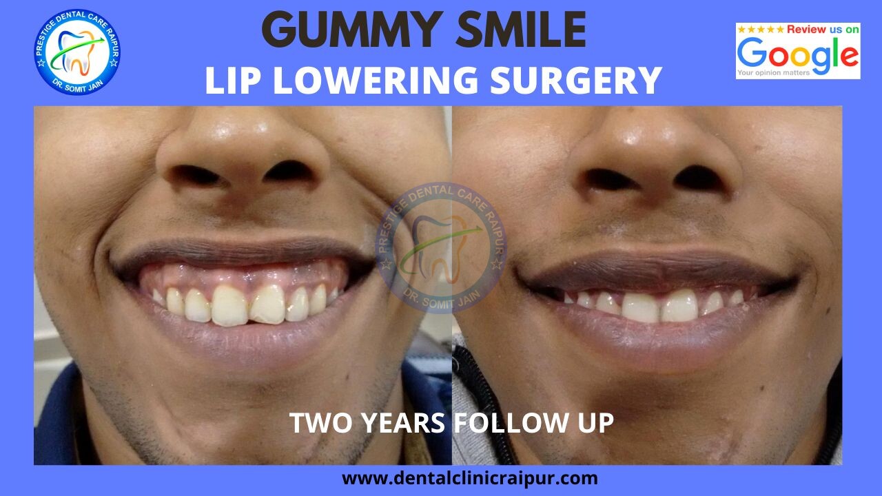 Lip lowering (repositioning) surgery for gummy smile