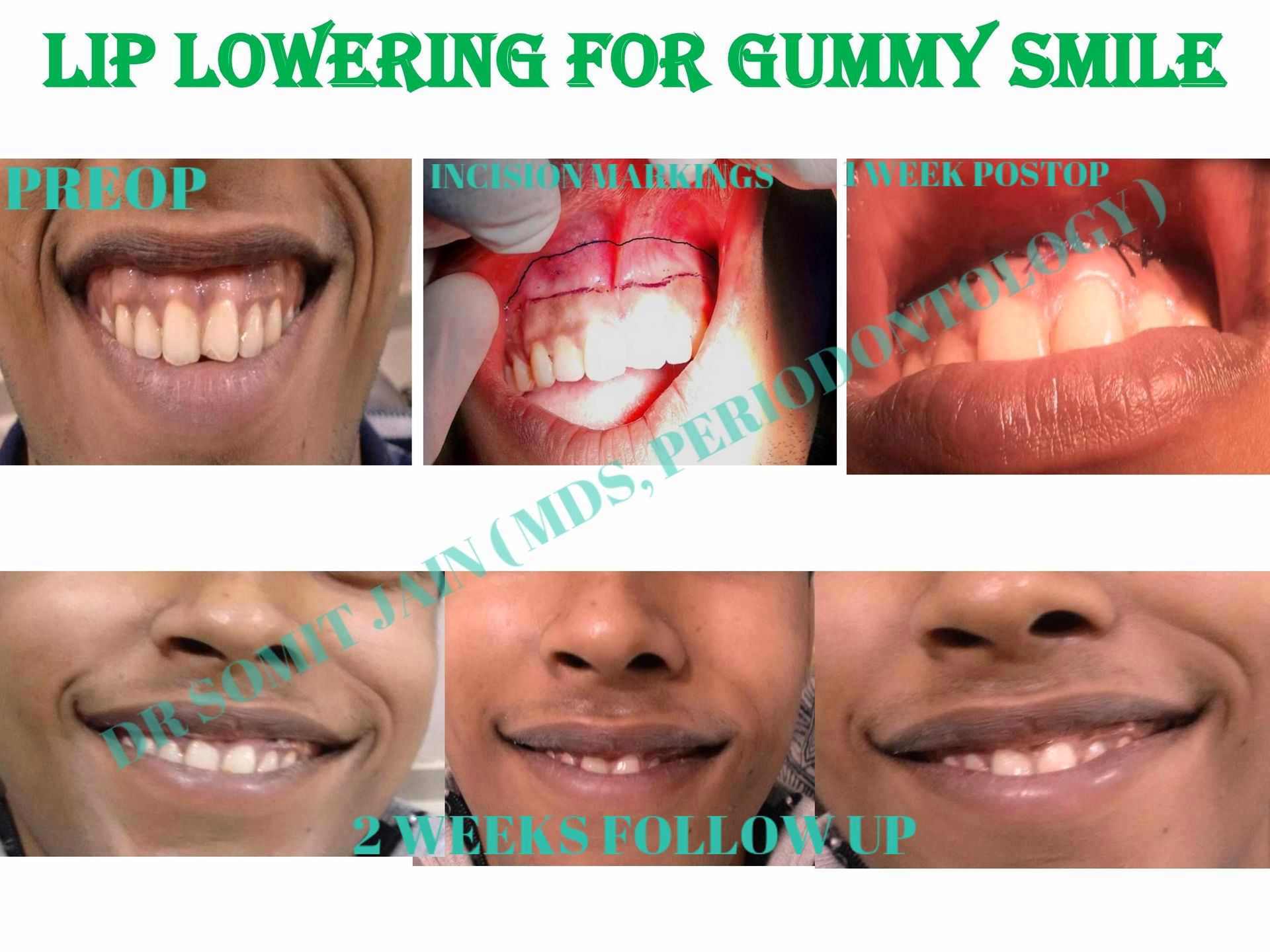 LIP LOWERING SURGERY BEFORE AND AFTER BY DR SOMIT JAIN