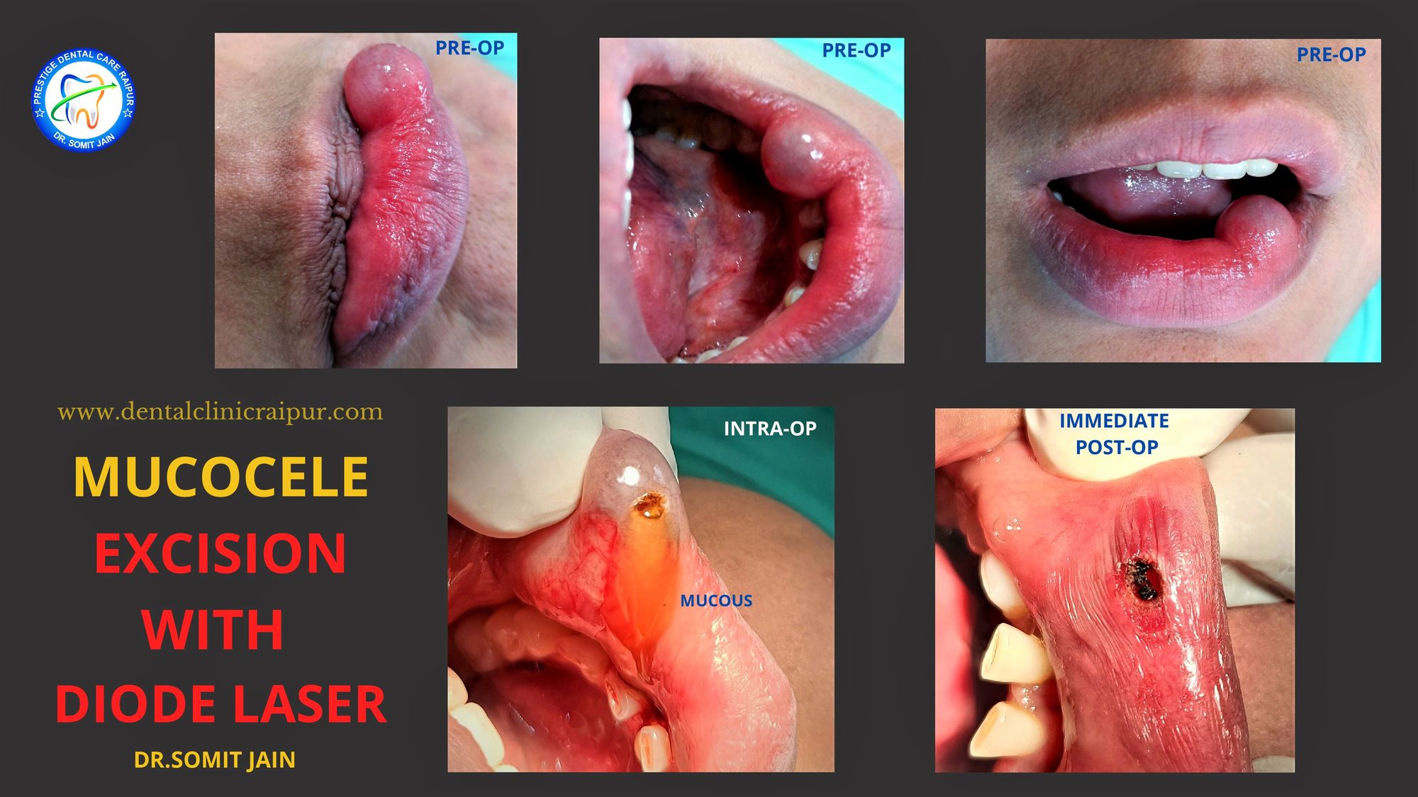 Excision of Mucocele Using Diode Laser in Lower Lip