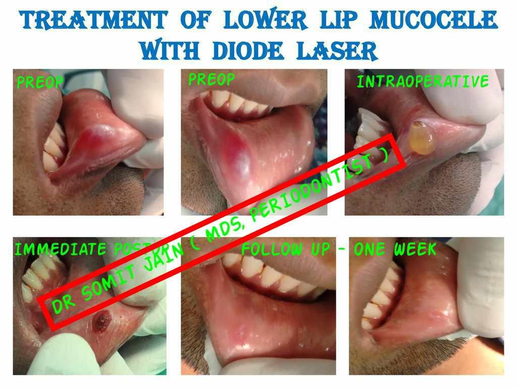 LIP-MUCOCELE-SWELLING-LASER