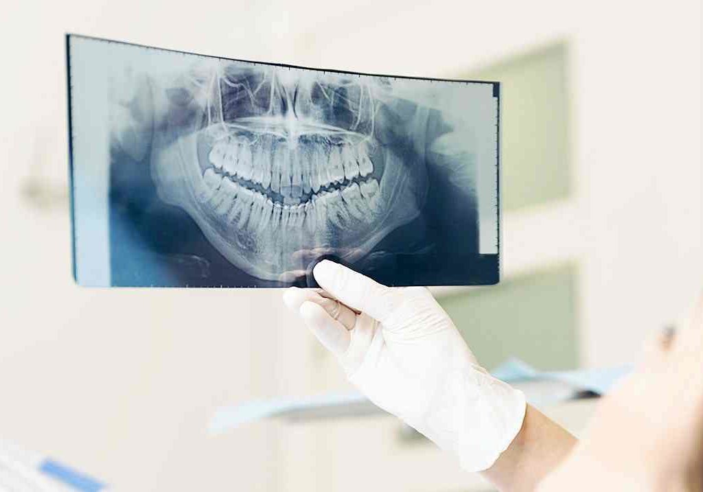 Orthopantamograph OPG of a dental patient