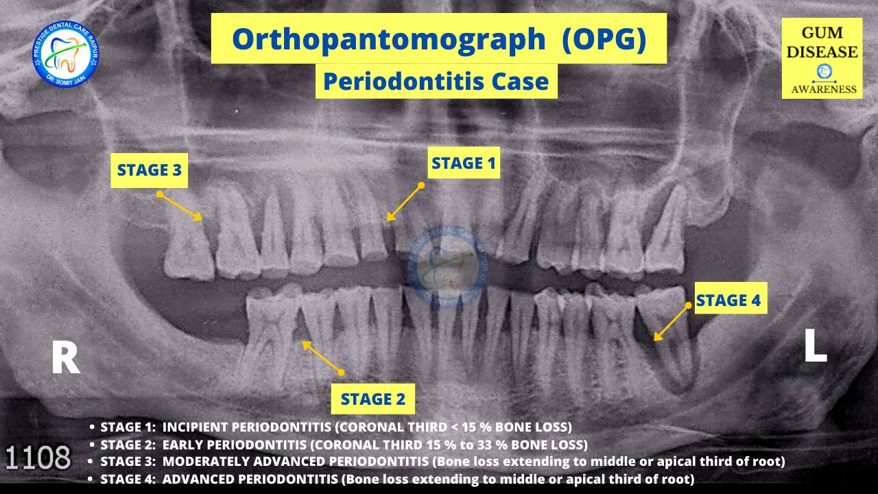 Orthopantomograph (OPG) PERIODONTITIS