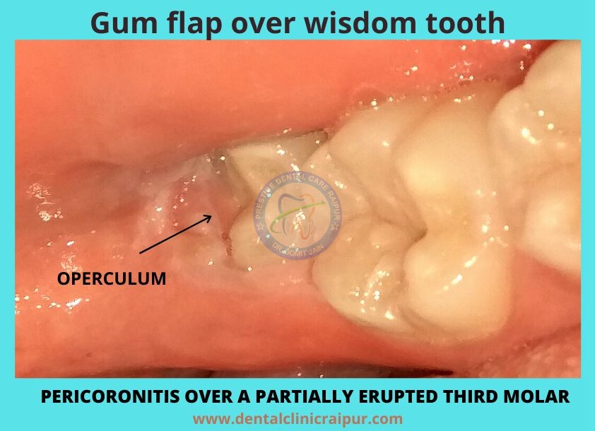 gum flap over wisdom tooth