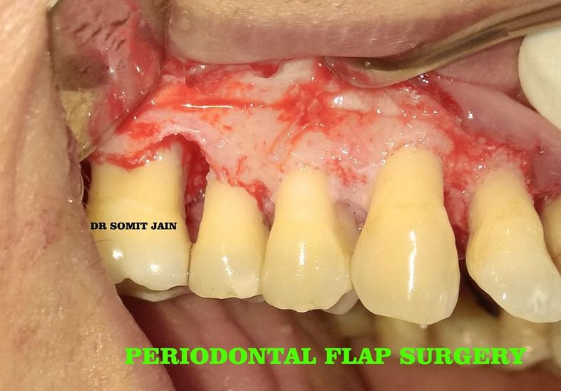 PERIODONTAL FLAP SURGERY- BY DR SOMIT JAIN dentist