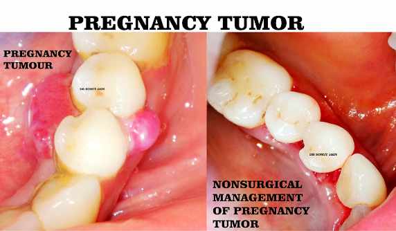 nonsurgical periodontal management of pregnancy tumor
