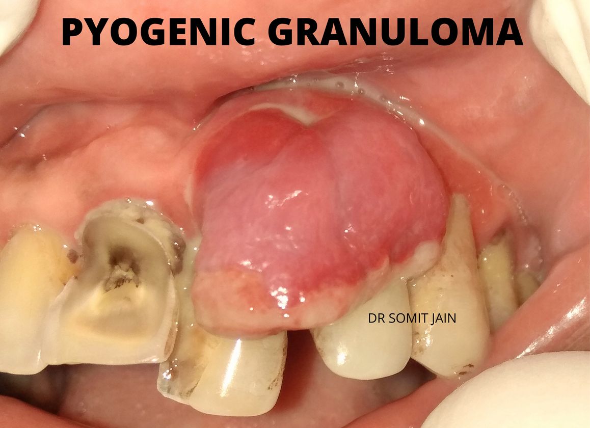 PYOGENIC GRANULOMA EPULIS