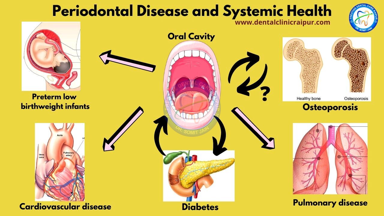 Periodontal Disease and Systemic Health