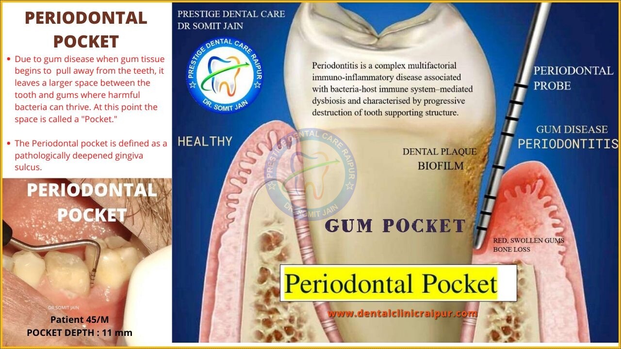 Periodontal Pocket (Gum pocket)