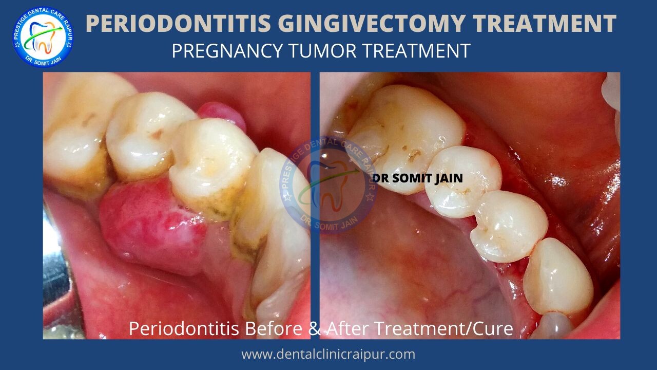 Periodontitis Gingivectomy treatment