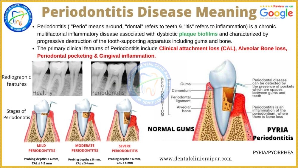 Periodontitis Meaning