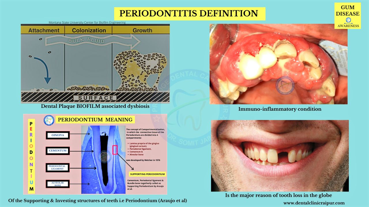 Periodontitis definition