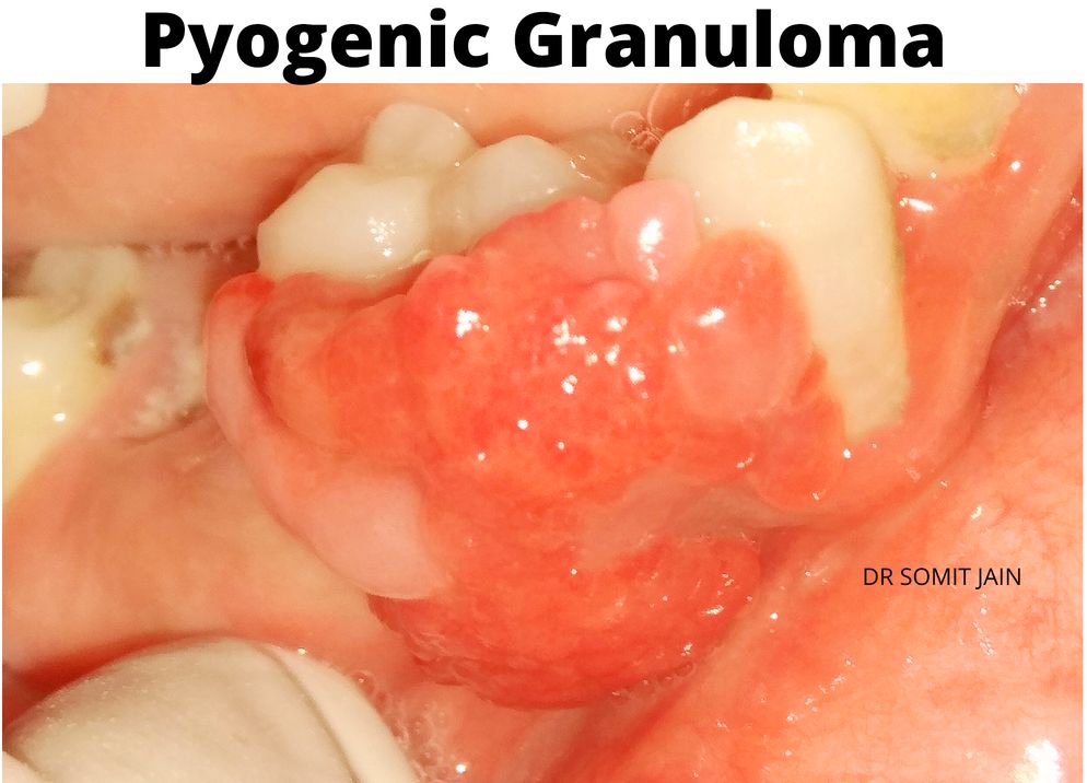 epulis pregnancy