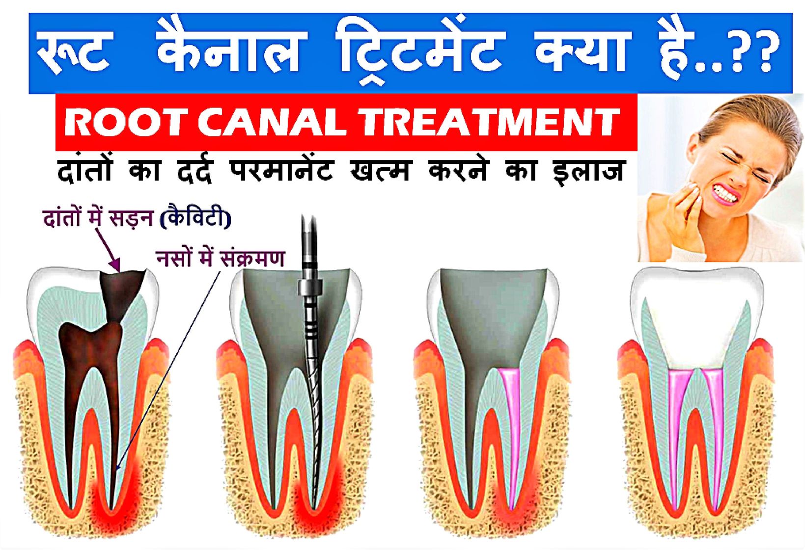 ROOR CANAL TREATMENT IN RAIPUR