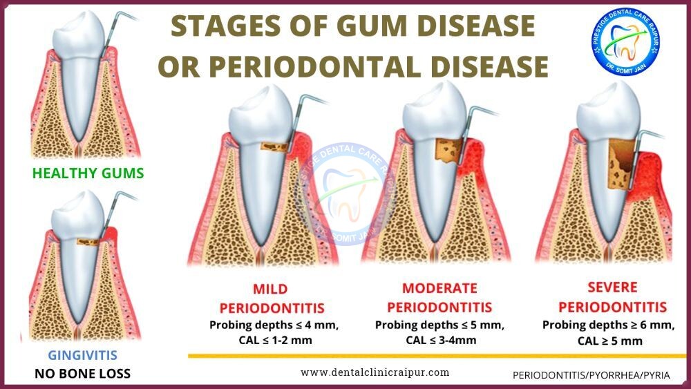 STAGES OF GUM DISEASE OR PERIODONTAL DISEASE