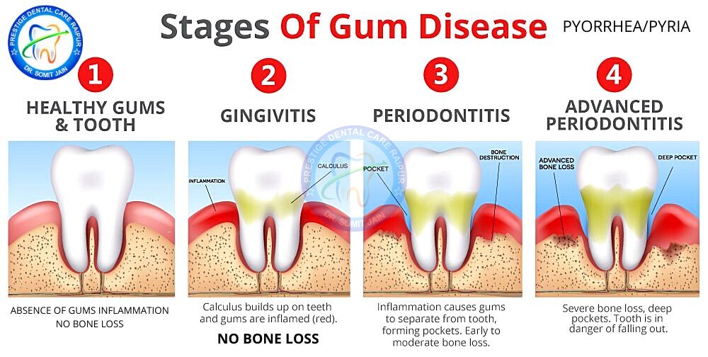STAGES OF GUM DISEASE
