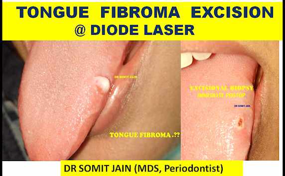 tongue fibroma removal by diode laser before and after