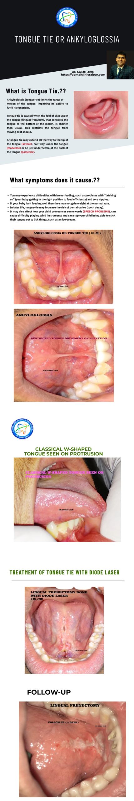 Tongue tie or Ankyloglossia Infographic