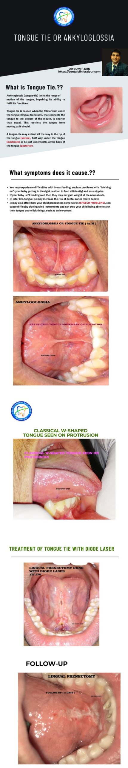 tongue-tie or Ankyloglossia Infographic