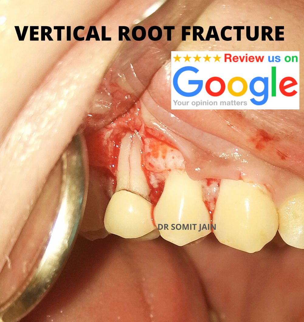 VERTICAL ROOT FRACTURE