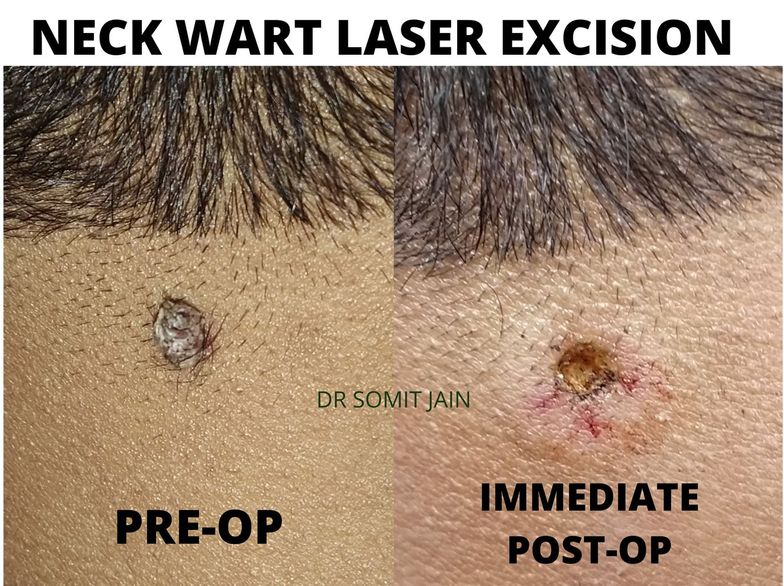 WART MOLE LASER REMOVAL