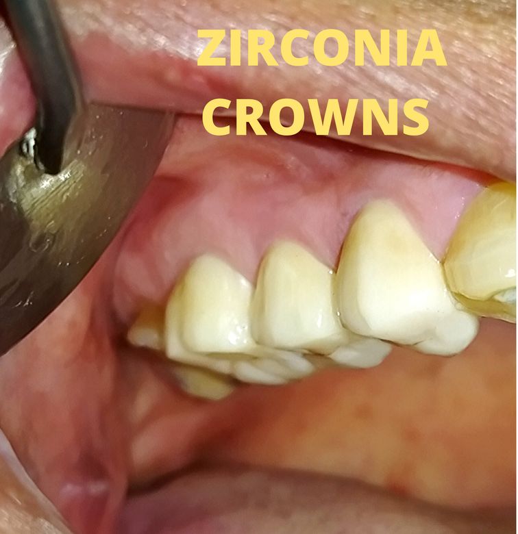 ZIRCONIA CROWN