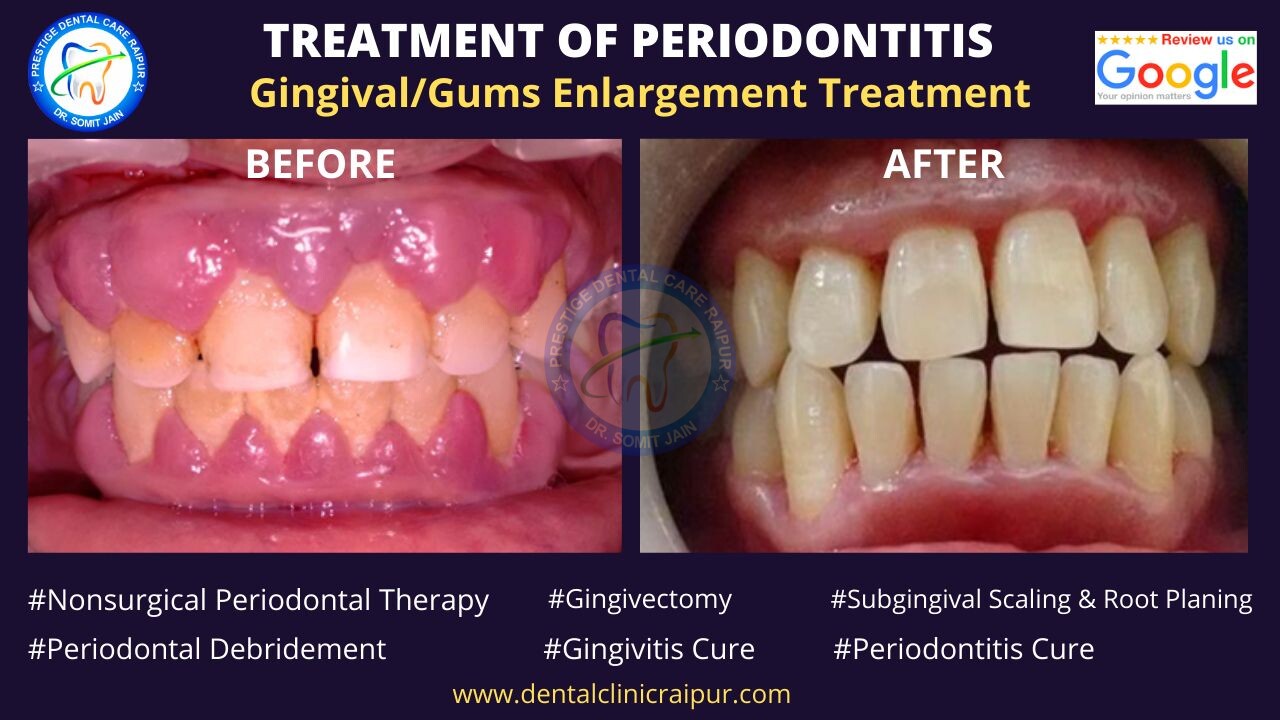 gingivectomy gums enlargement treatment