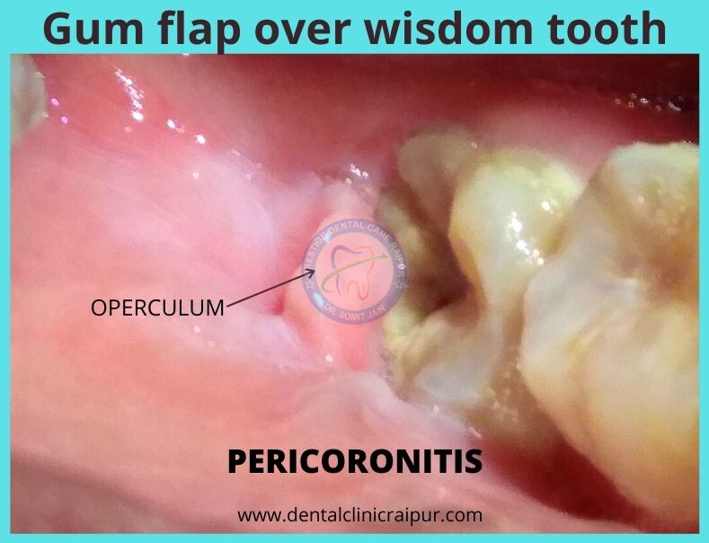 gum flap over wisdom tooth